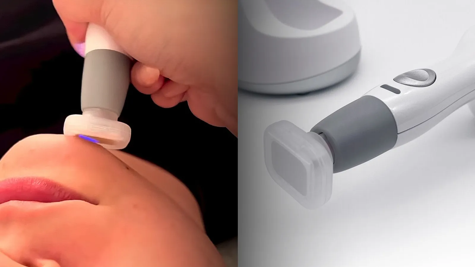 Jet Plasma Skin Renewal