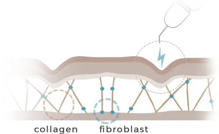 Plasma Skin Tightening